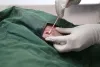 O ideal é que a remoção da berne em cachorro seja feita por um médico veterinário para não piorar o problema